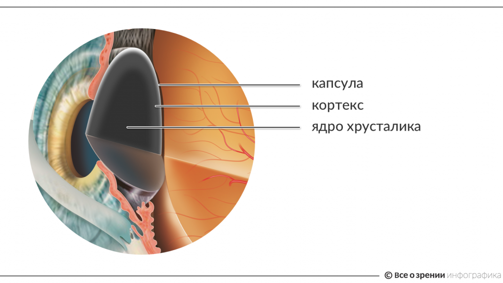 Что такое катаракта? Причины, симптомы, лечение