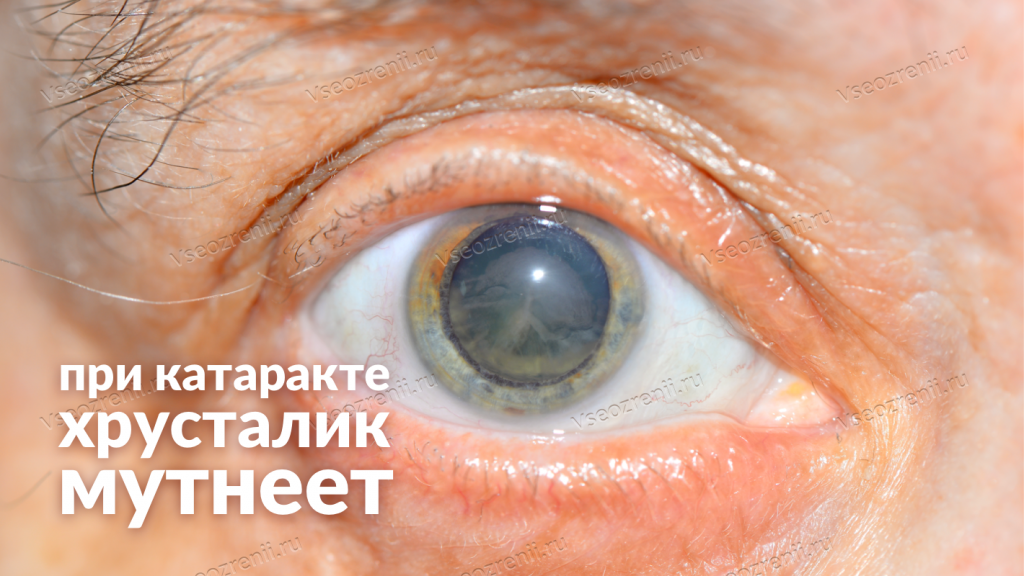 Возрастная катаракта – стадии, виды, лечение